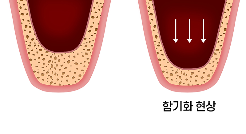상악동함기화모식도